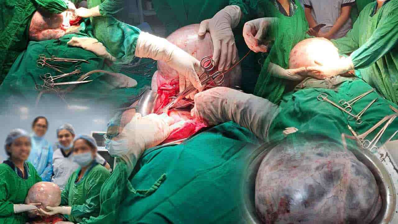 கருப்பையில் இருந்து அகற்றப்பட்ட 10 Kg கட்டி!
