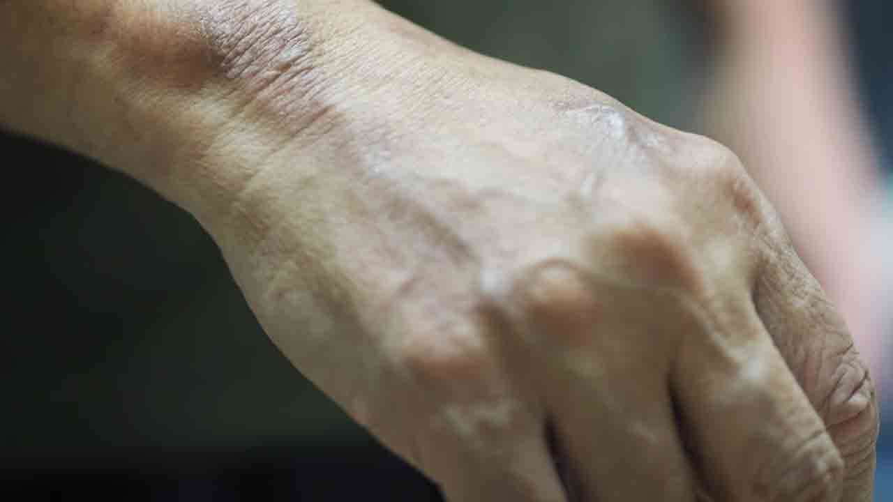 ஆயிரத்தை கடந்த தொழுநோயாளர்களின் எண்ணிக்கை