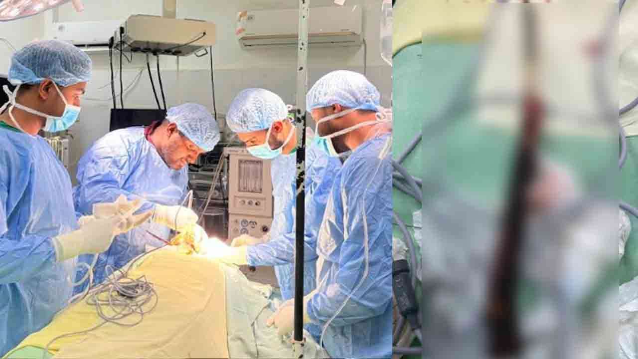 வைத்தியர்களினால் வெற்றிகரமாக அகற்றப்பட்ட கூரிய தடி