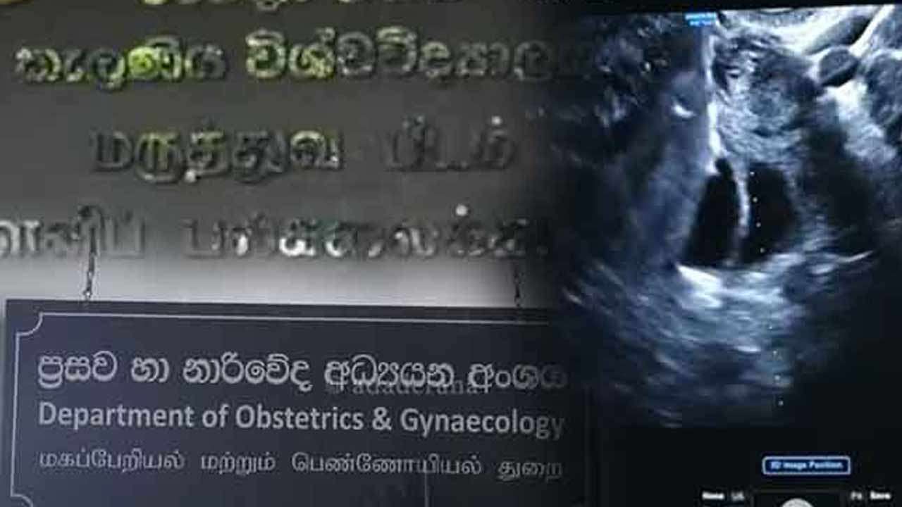 IVF முறையில் முதலாவது செயற்கை முறை கருத்தரிப்பு வெற்றி