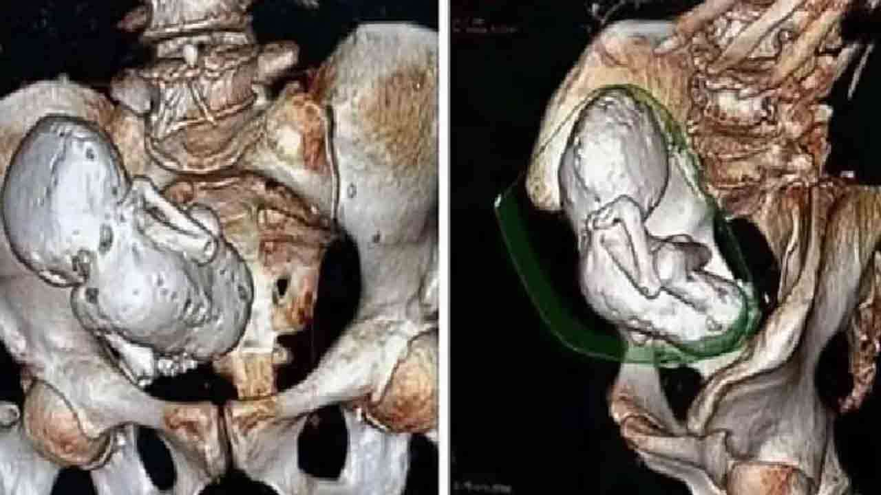 30 ஆண்டுகளாக பெண் வயிற்றில் இருந்த சிசு!